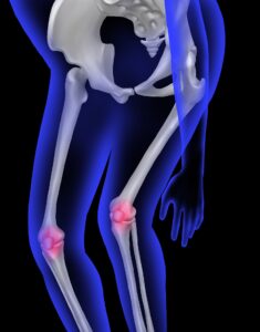 러닝 무릎 통증 원인인 슬개건 인장 전단 부하 감소와 고유수용성 감각 예열을 통한 하지 관절 보호 기전